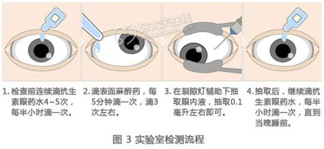 眼睛有波紋|持續性閃光或水波紋狀態：是否為無害的眼疾？